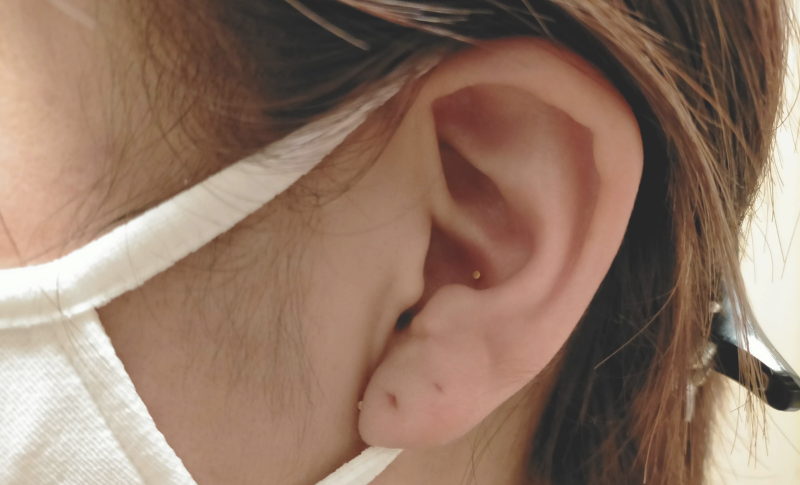 突然の痛みに対して耳鍼をうけた女性